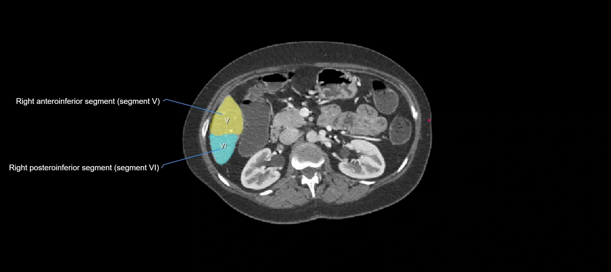 CT liver segments axial cross sectional anatomy labelled image-00022.webp